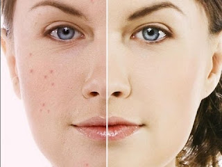 Masque visage peaux grasses ou acnéiques