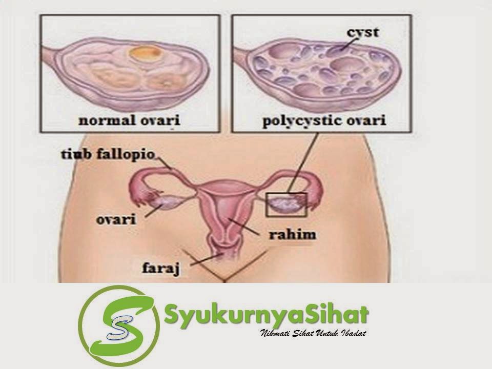 Cara Mendapatkan Cahaya Mata Kesayangan PCOS, produk shaklee