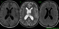 qarc medulloblastoma qarc medulloblastoma