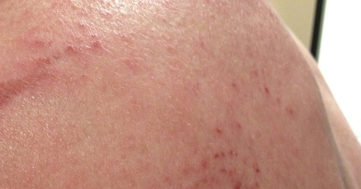 Healing Eczema and Cortisone Withdrawal Symptoms Oedema and Eczema