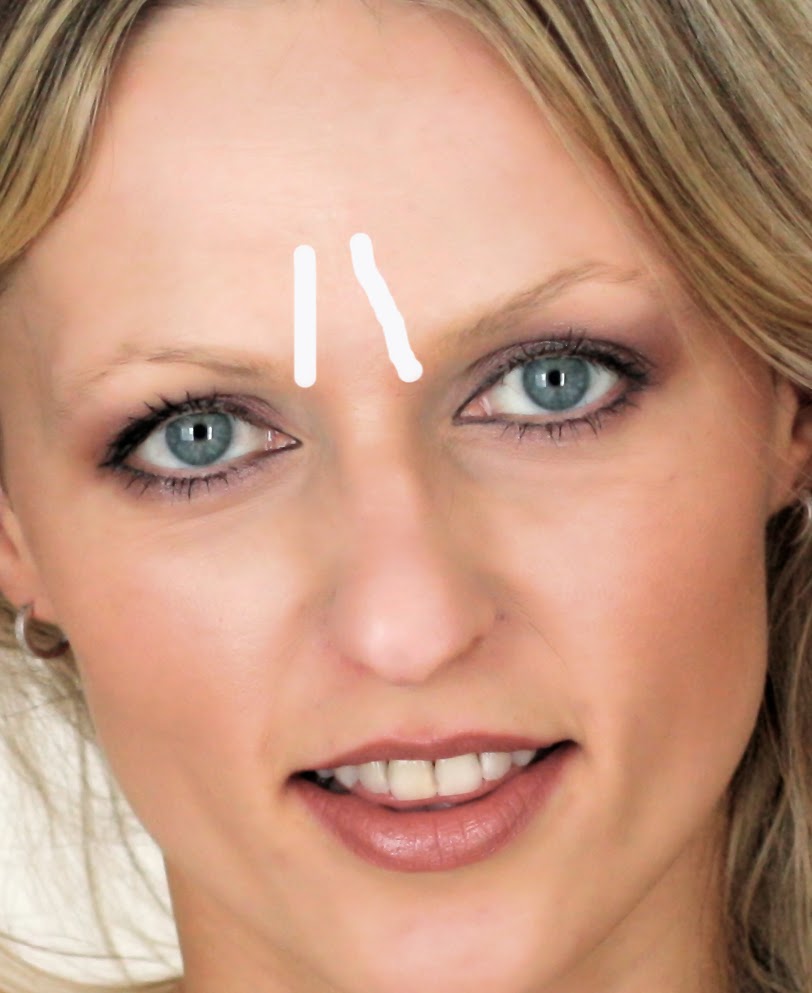 Botox in the forehead, or stop frowning Botox in the forehead, or stop frowning