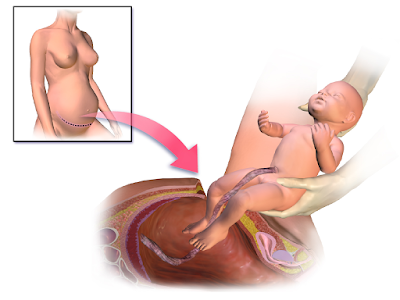 tips that you can do to shrink the stomach after caesarean section.