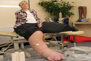 ساق امرأة بريطانية تزن 108 كيلوجرامات