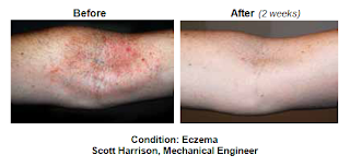 Steroid cream side effects psoriasis