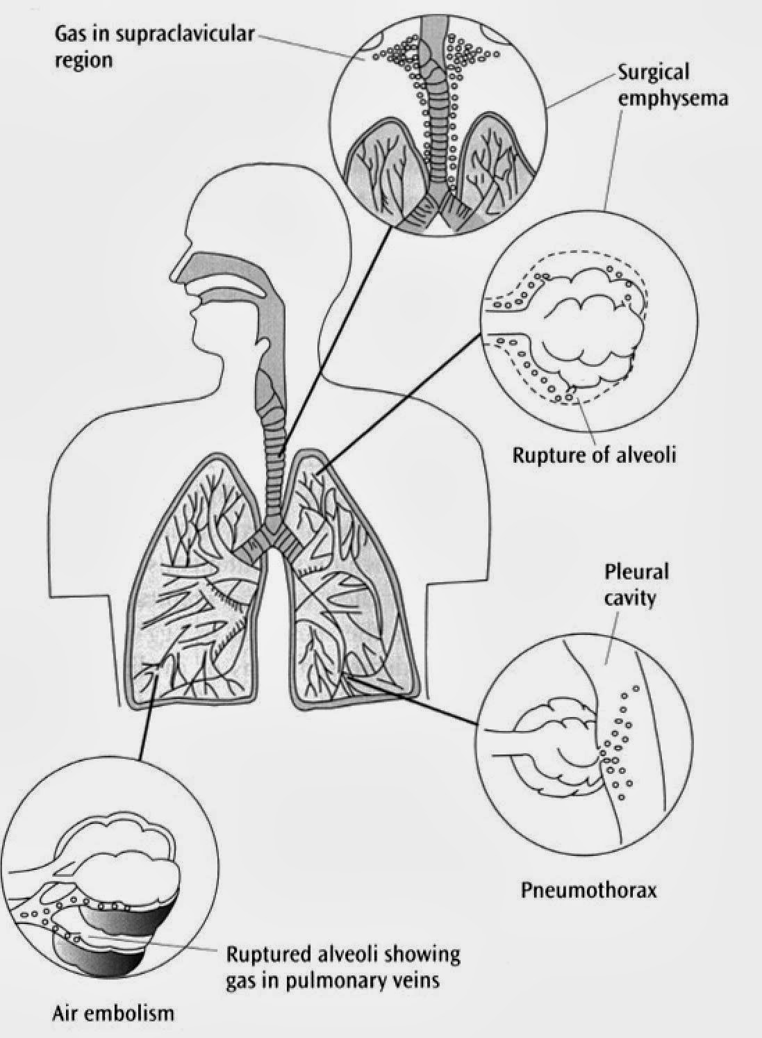 ER goldbook การบาดเจ็บจากแรงดัน (Barotrauma) และโรคจากการลดความดัน