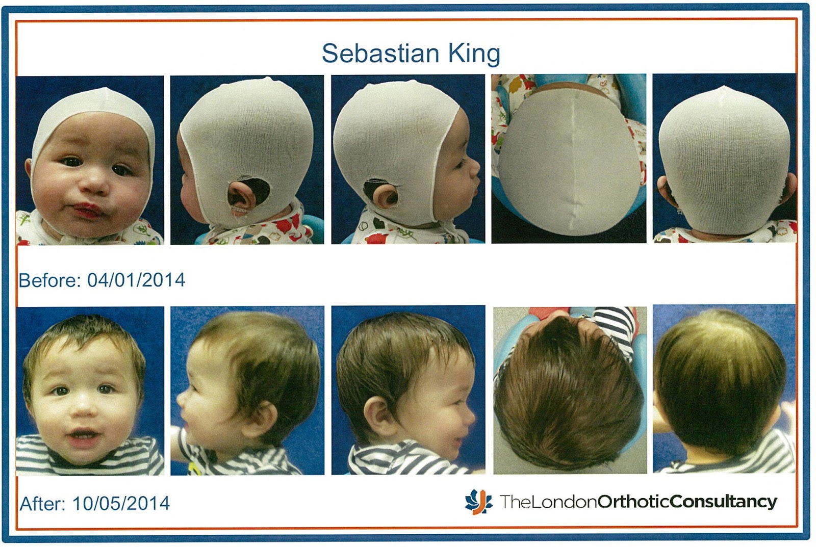 plagiocephaly no helmet