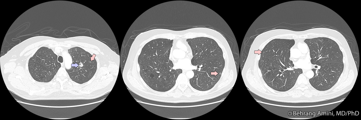 Roentgen Ray Reader Focal Pure GroundGlass Opacities in the Setting