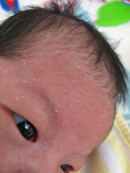 乳児湿疹と脂漏性湿疹 Mayblog