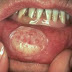 Kanker Rongga Mulut (Squamous Cell Carcinoma) thumbnail