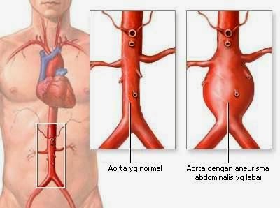 Obat Tradisional Penyakit Aneurisma Obat Tradisional Penyakit Aneurisma