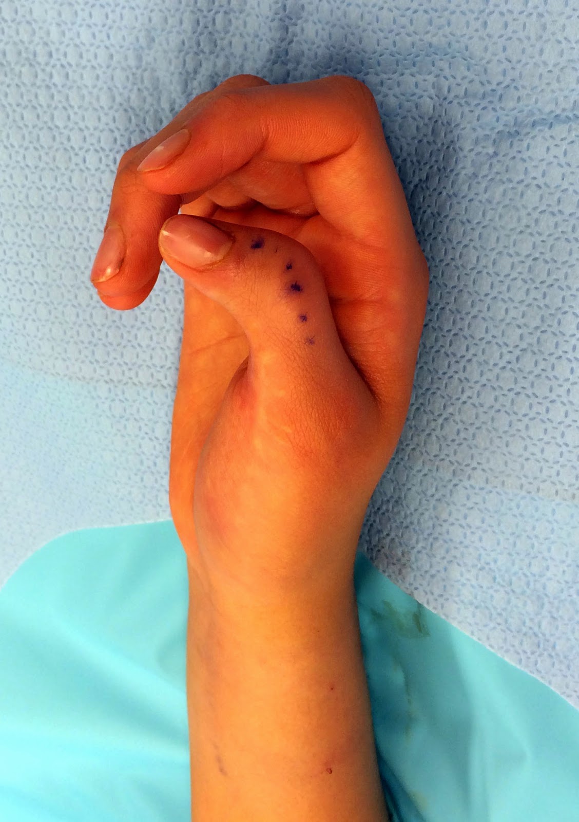 Thumb Deformity after Polydactyly Reconstruction Congenital Hand and Arm Differences