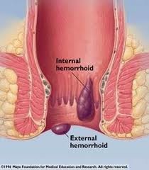 Image Cari Obat Ambeien Herbal Ampuh