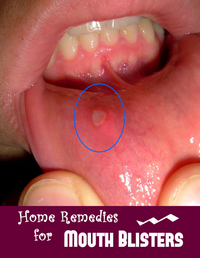 Home Remedies Mouth Ulcers Adults Home Remedies Mouth Ulcers Adults