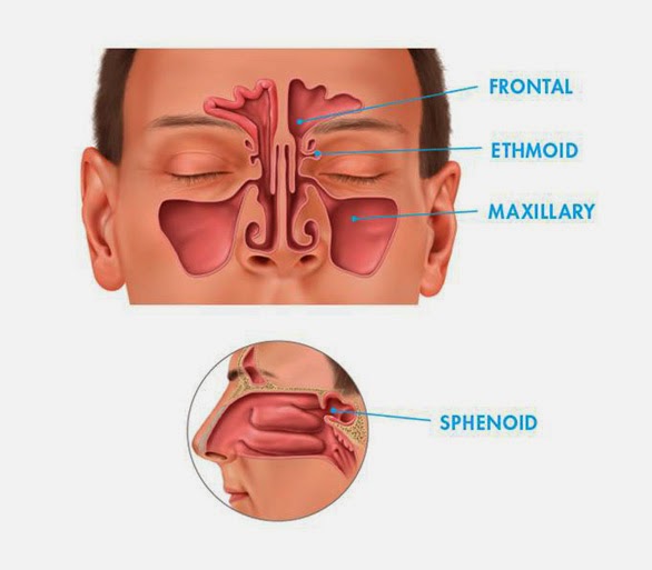 Aerosinusitis or Barosinusitis Dr Impo