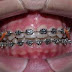 Los "brackets" están de moda en Dominicana; hasta personas con prótesis dentales los usan