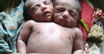 Three Headed Baby Born in Jefferson County