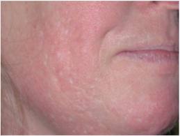Topical steroid for cystic acne