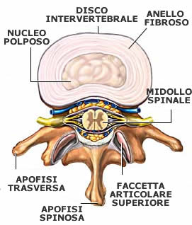 Cura omeopatica di ernia di una spina dorsale