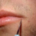 Different Ways On How To Remove Warts - How To Get Rid of Warts