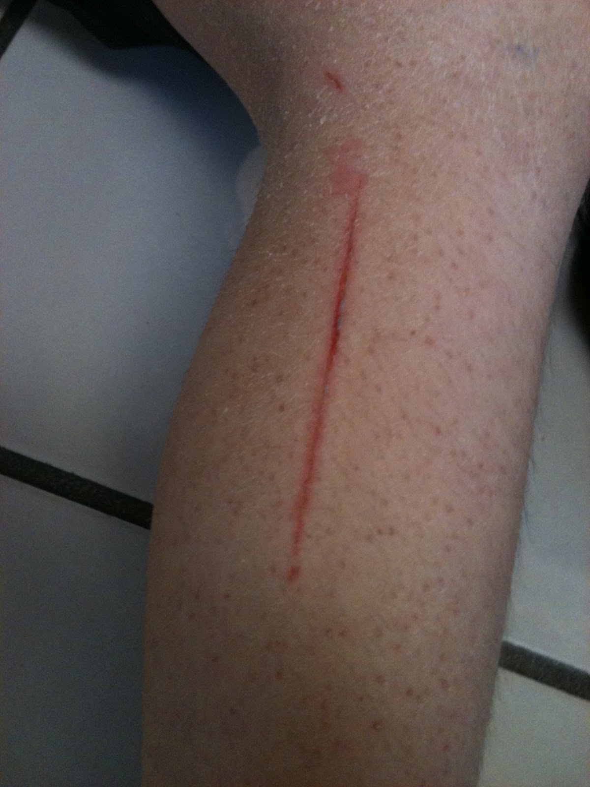 cast saws can cut skin amber argyle