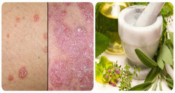 Natural Cure for the Psoriasis and Other Skin Diseases With This Recipe Natural Cure for the Psoriasis