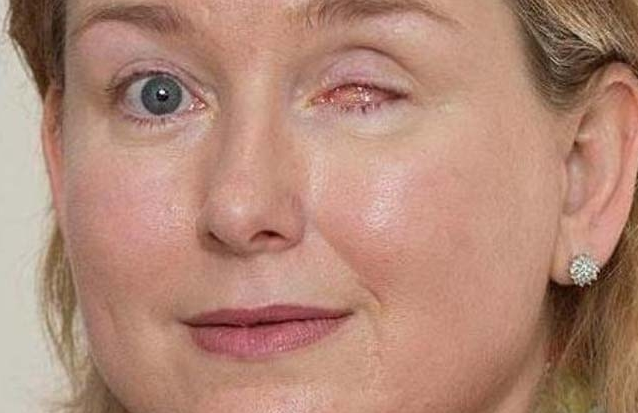Los ejercicios para las arrugas mímicas bajo los ojos