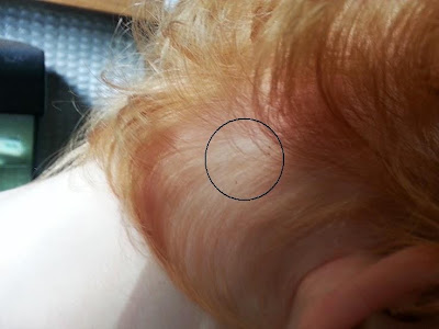 lice head headlice hair nit spot fly child jump months even uninitiated had lot human start actually case being take