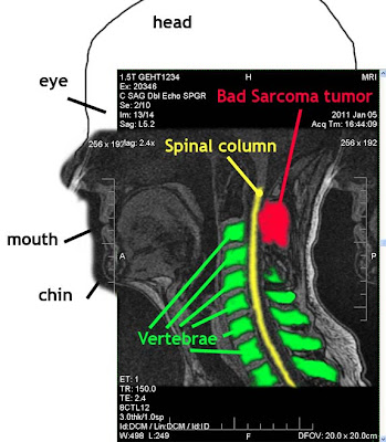 MRI of sarcoma tumor near spine and cervical vertebrae C1 C2 in neck by Selep Imaging