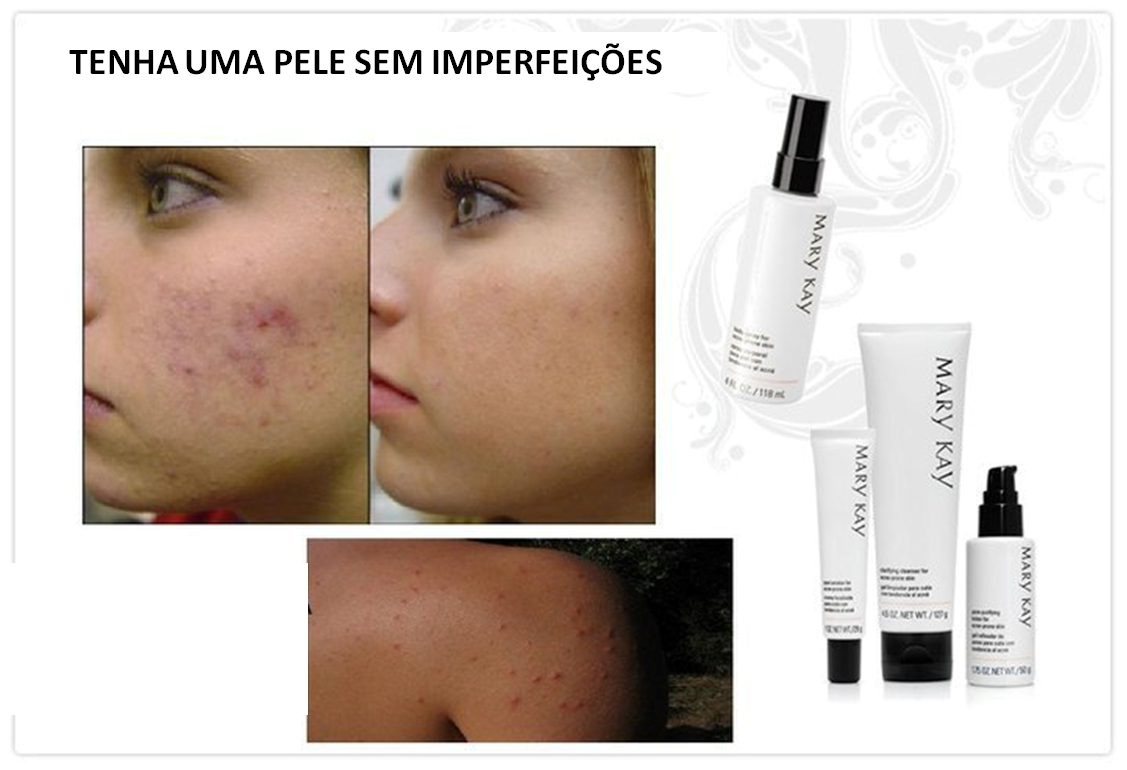 Bela & Fantástica Tratamento para Acne Mary Kay