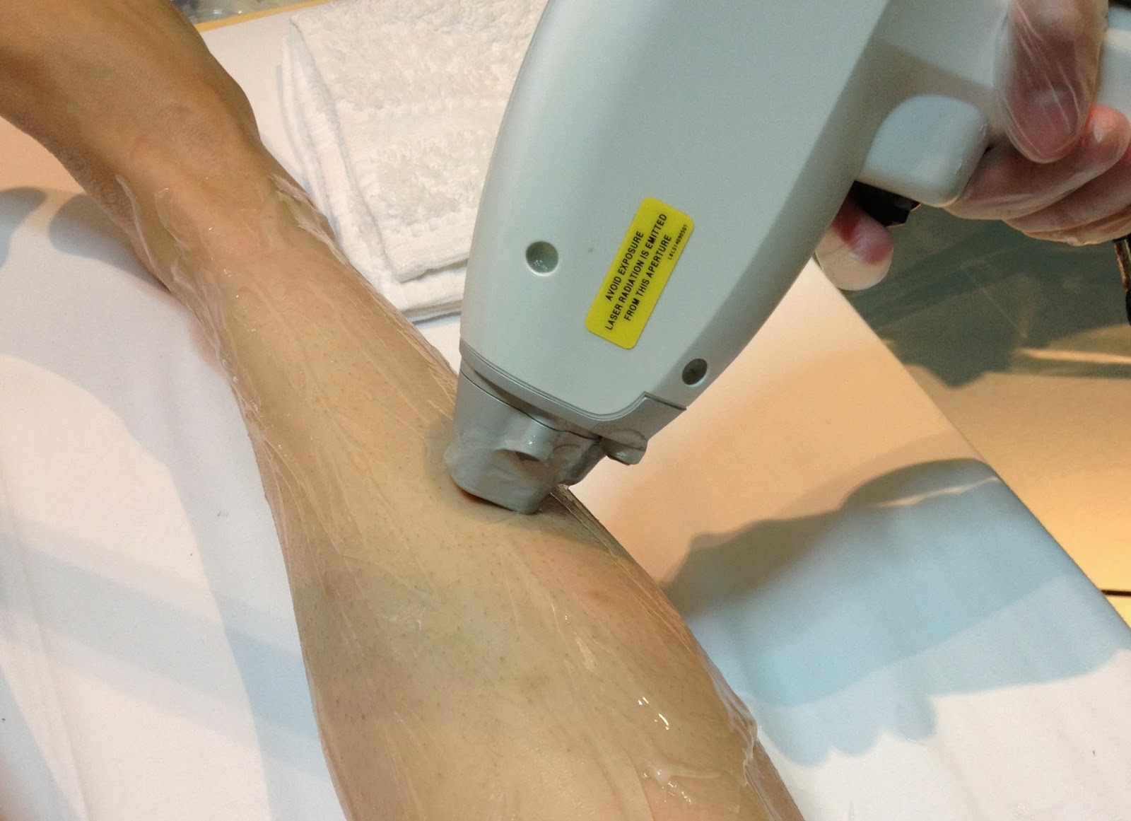 manila fashion observer Hair Free Diary Leg Hair Laser Removal, Session 1