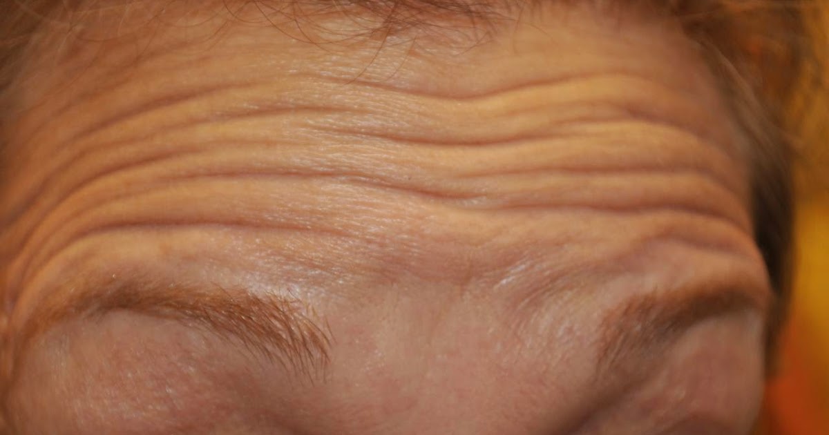 La osteocondrosis y los hinchazones bajo los ojos
