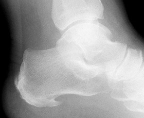 Calcaneal Spur