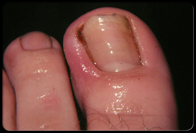 Ingrown toenail diabetes problems foot nail herbal cmm toenails disease pakistan toe skin CMM Herbal Products In Pakistan: Diabetes and Foot Problems. CMM