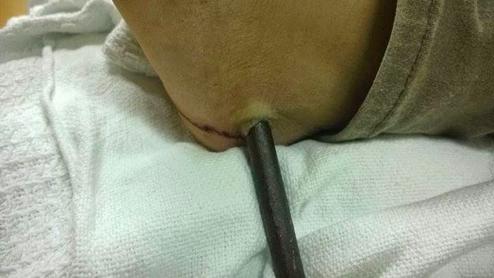 Kaki Wanita Tercucuk Besi female legs punctured metal, iron punctured foot, Ngeri! Kaki Wanita Tercucuk Besi, Kaki Tercucuk Paku, Besi Tembus Kaki,