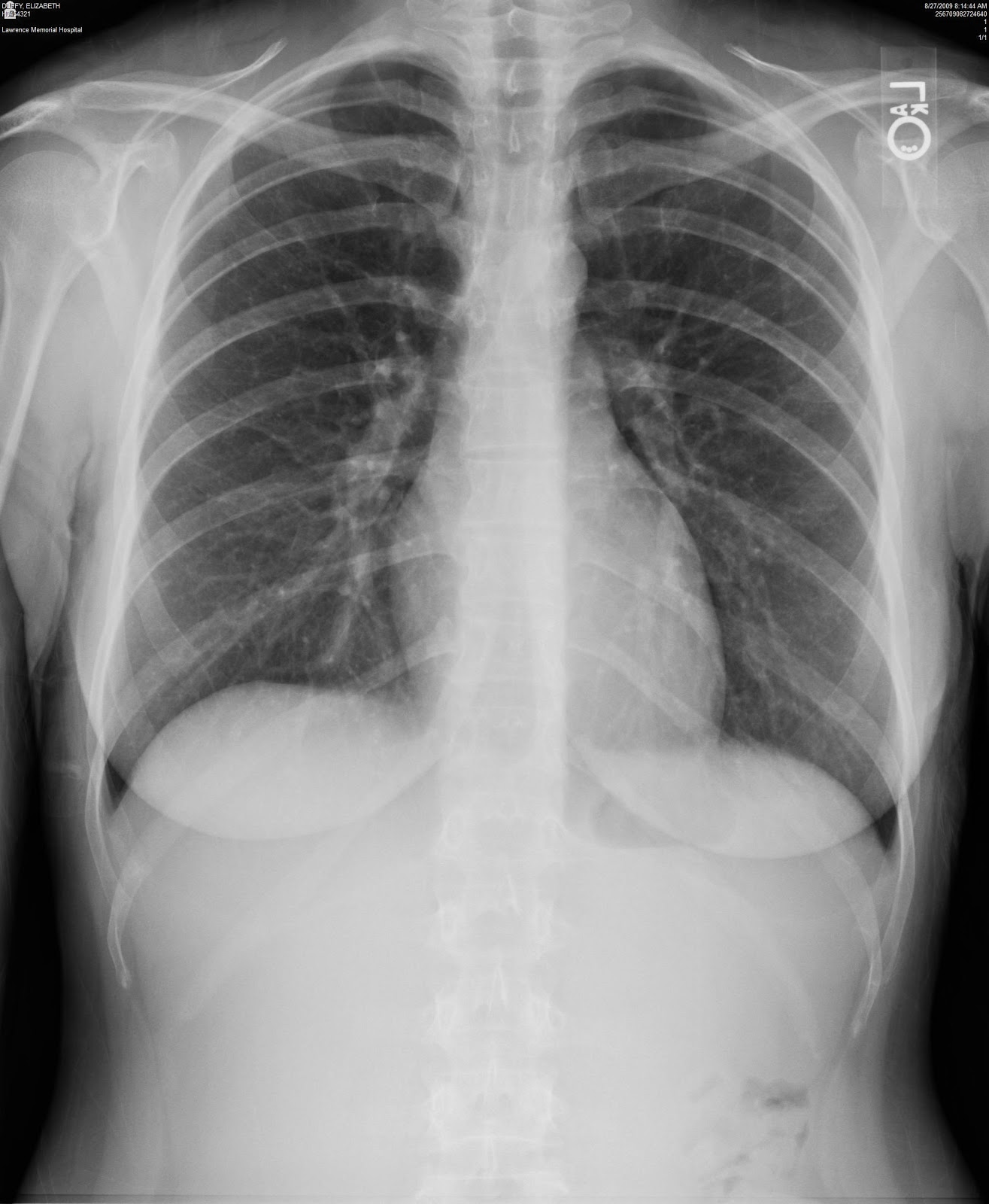 Mashing Myeloma November 2012