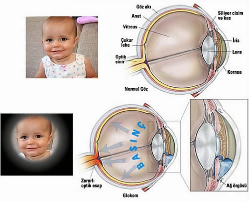 Saglik Ve Mutluluk Icin Goz Tansiyonu Hastaligi Goz Tansiyonu Belirtileri Ve Tedavisi