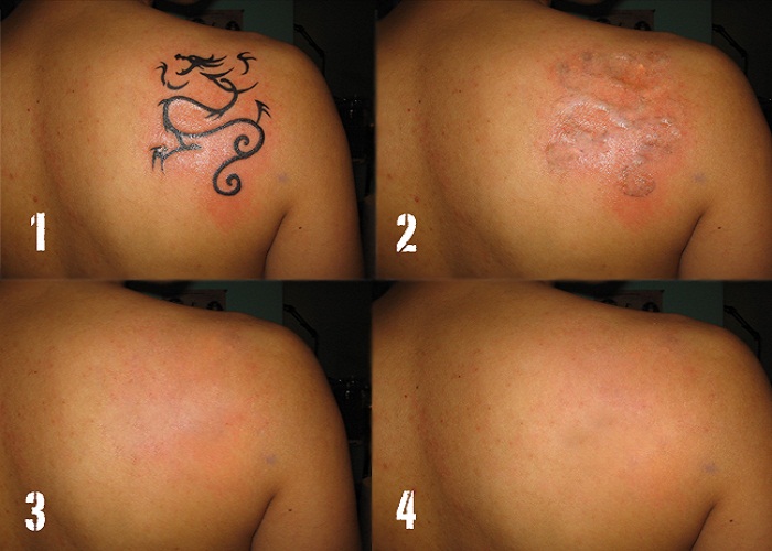 Laser Tattoo Removal Cost Laser Tattoo Removal Cost