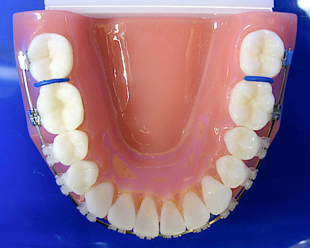 Burleson Orthodontics Braces Invisalign Orthodontist Kansas City