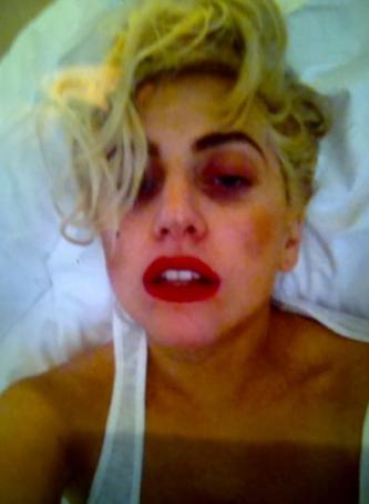Lady Gaga black eye