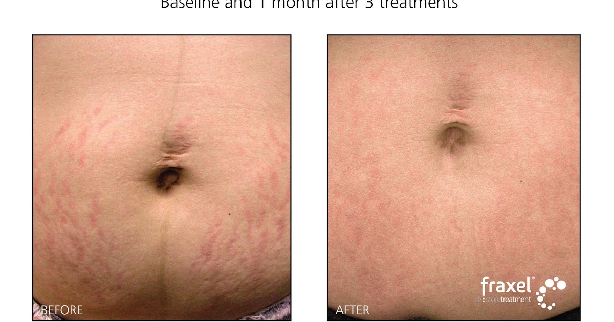 Fraxel Laser Clinic laser stretch marks treatment with fraxel Sydney