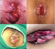 Obat Untuk Wasir Ringan Obat Untuk Wasir Ringan
