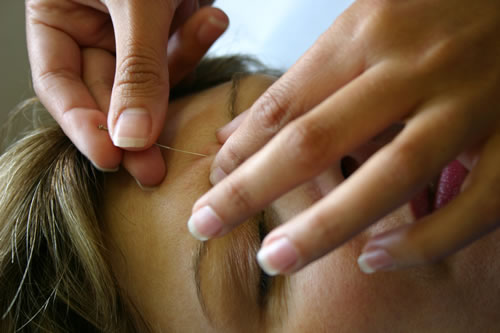 Can Acupuncture Help You Get Pregnant Naturally Can Acupuncture Help You Get Pregnant Naturally