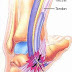 Heel Spur Relief - What Is Tarsal Tunnel