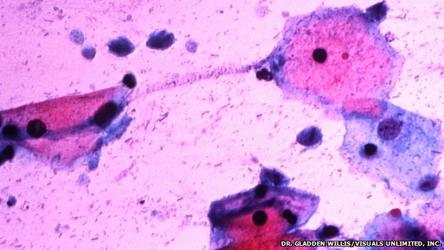 Prostate Cancer 'May Be A Sexually Transmitted Disease'