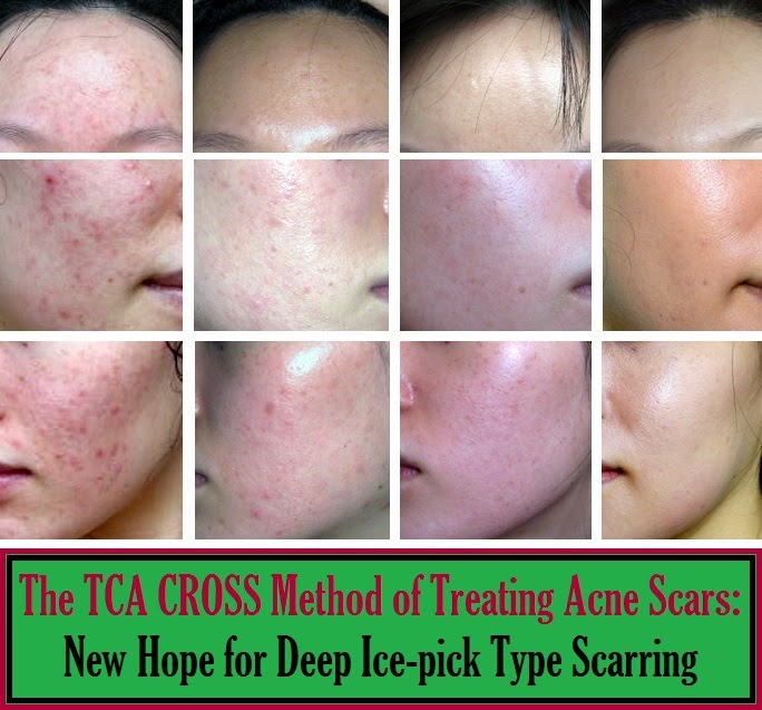 The TCA CROSS Method of Treating Acne Scars New Hope for Deep Icepick