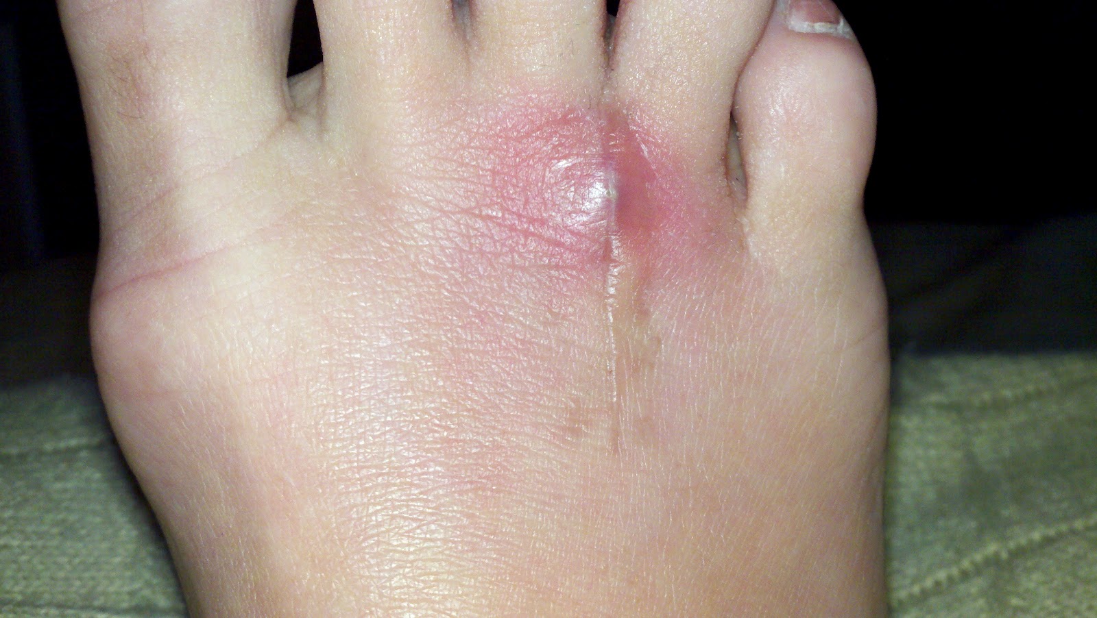 Finding Out the Hard Way Overdoing it is still possible 8 weeks postop!