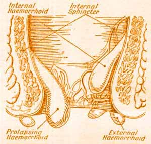 piles pictures and symptoms diagrams the complete guide to hemorrhoids how to get rid of piles pictures and symptoms diagrams the complete guide to hemorrhoids how to get rid of