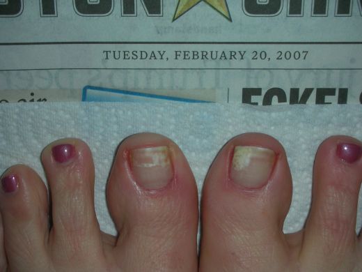 Acrylic Nails Types Nail Fungus Antifungal Nail Polish