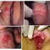 Jual Obat Sipilis Tradisional Alami thumbnail