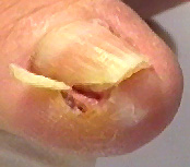 ongle incarné